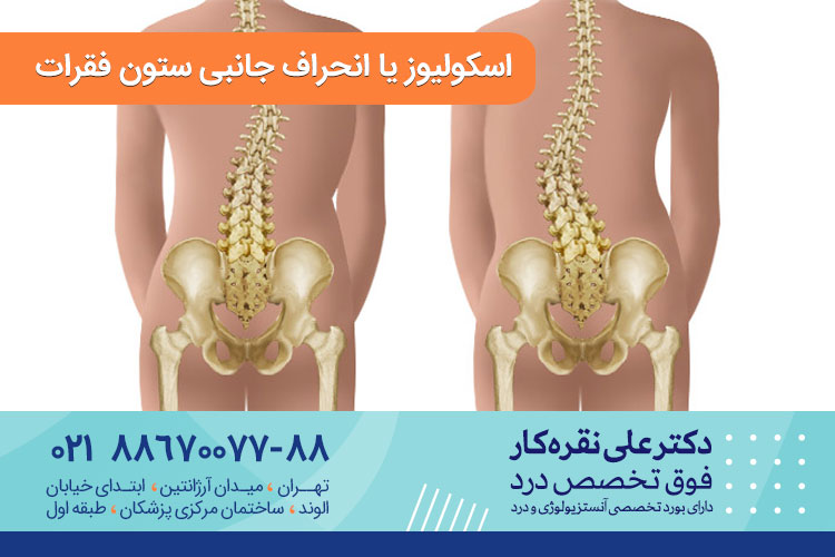 انحراف جانبی ستون فقرات