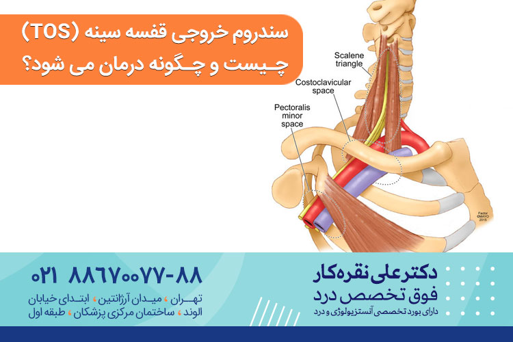 سندروم خروجی قفسه سینه