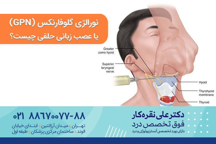 نورالژی گلوفارنکس