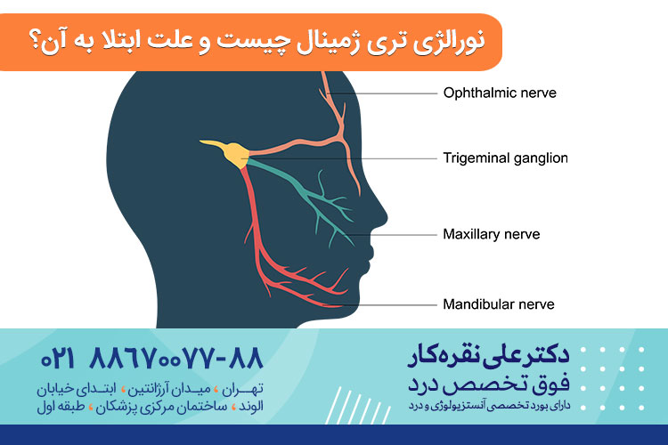 نورالژی تری ژمینال