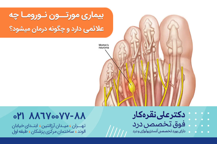 بیماری مورتون نوروما چه علائمی دارد