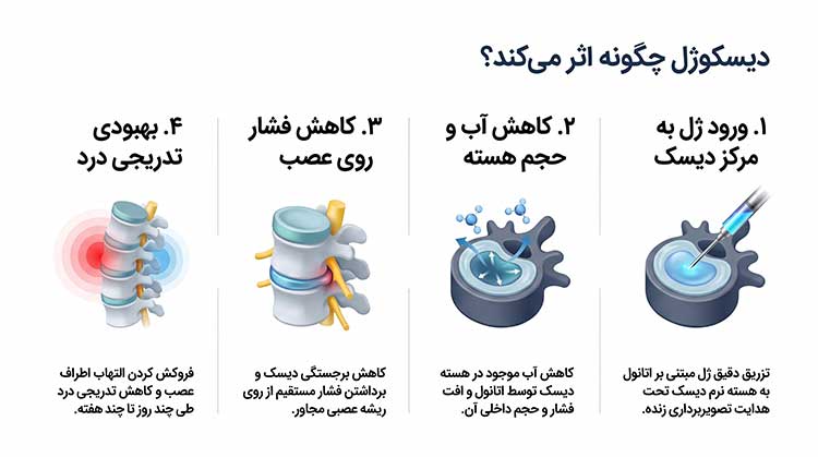 نحوه عملکرد ژل تزریقی دیسک