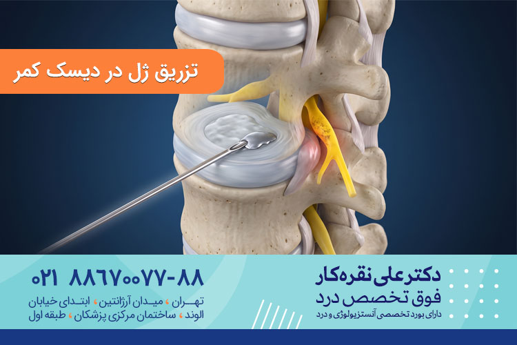 تزریق ژل دیسک کمر