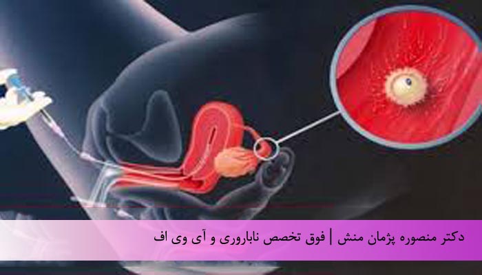 بهترین زمان انجام آی یو آی