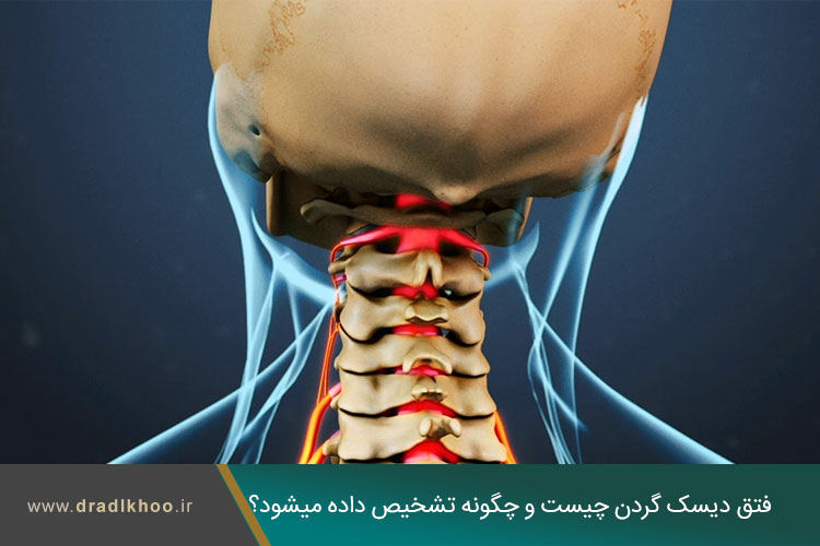 درمان فتق دیسک