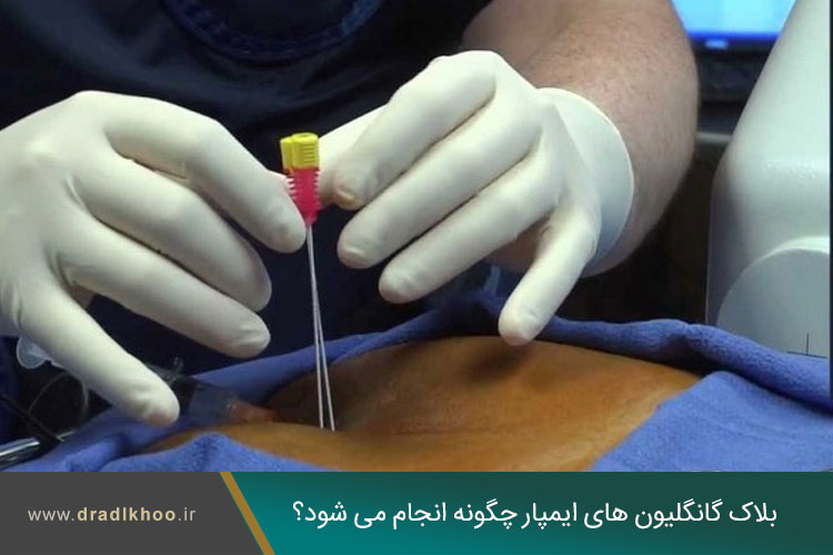 بلاک گانگلیون های ایمپار