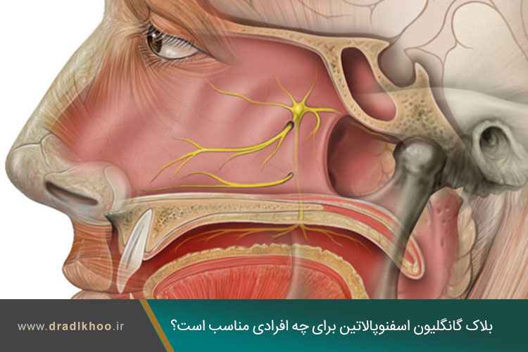 بلوک عصبی اسفنوپالاتین