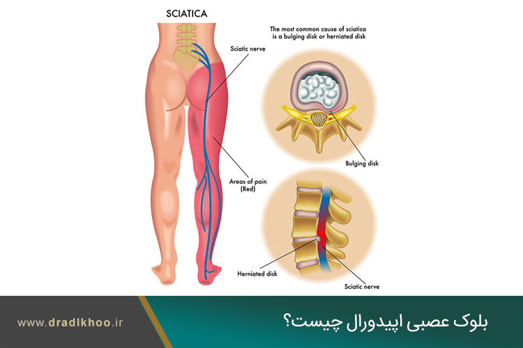 بلوک عصبی کودال