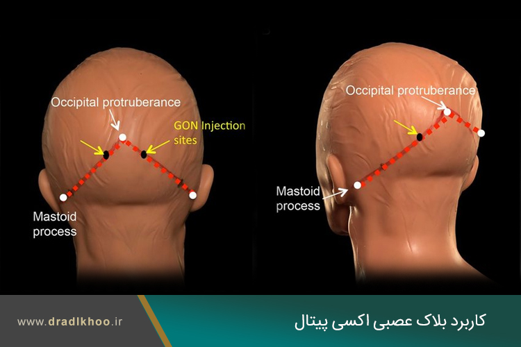 بلاک عصبی اکسی پیتال
