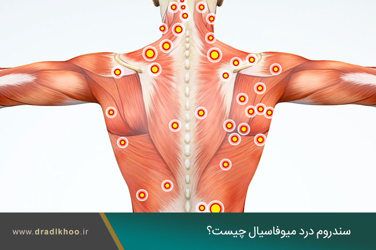 سندروم درد میوفاسیال