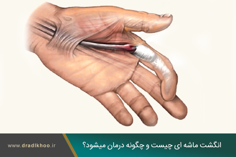 انگشت ماشه ای چیست و چگونه درمان میشود؟	