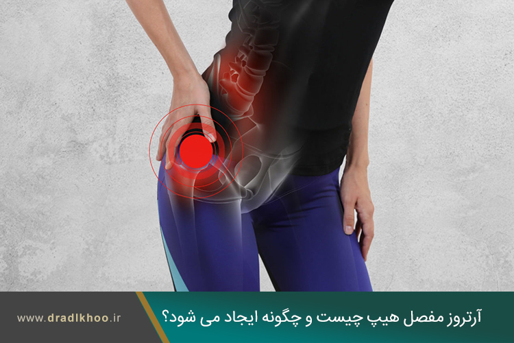 آرتروز مفصل لگن