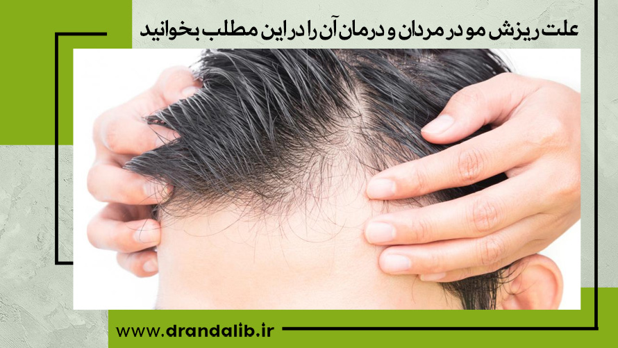 علت ریزش مو در مردان