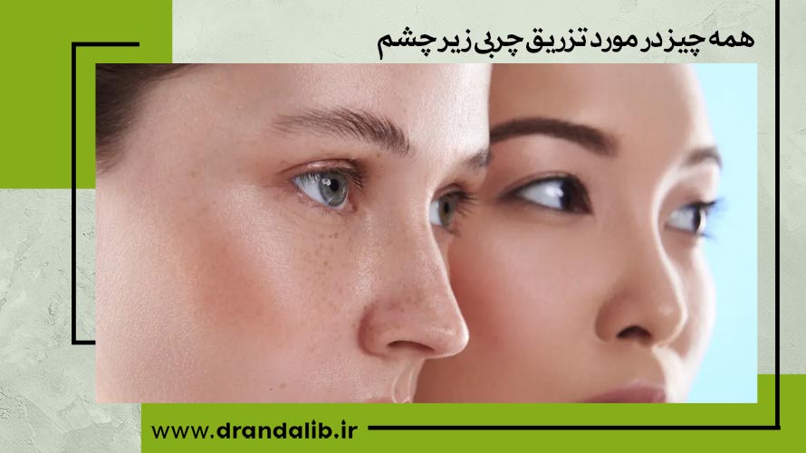 همه چیز در مورد تزریق چربی زیر چشم