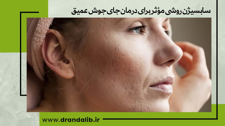 سابسیژن روشی مؤثر برای درمان جای جوش