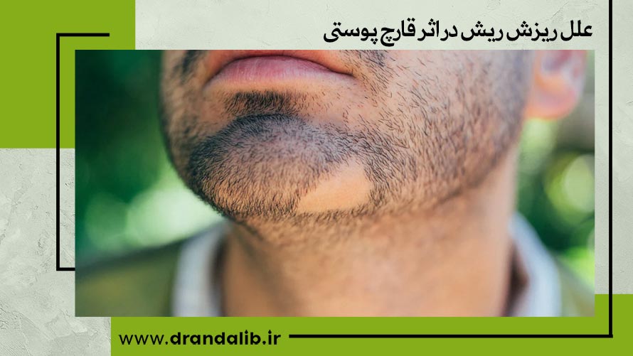 علل ریزش ریش در اثر قارچ پوستی