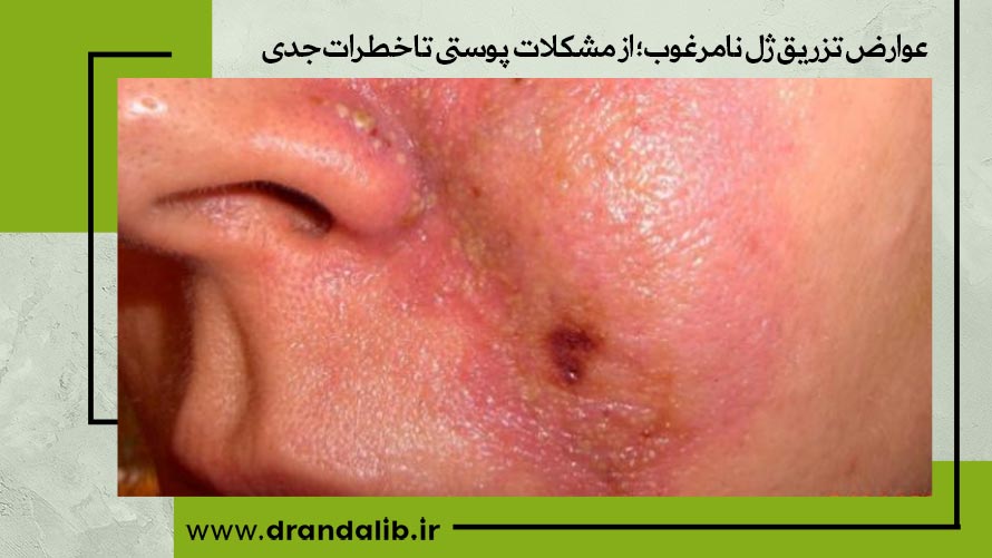 عوارض ژل نامرغوب 