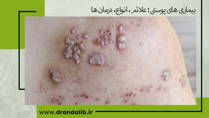عکس بیماری های پوستی