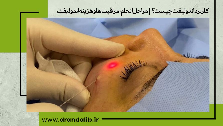 کاربرد اندولیفت چیست