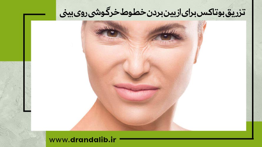 خطوط خرگوشی روی بینی 