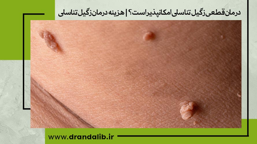 درمان زگیل تناسلی 