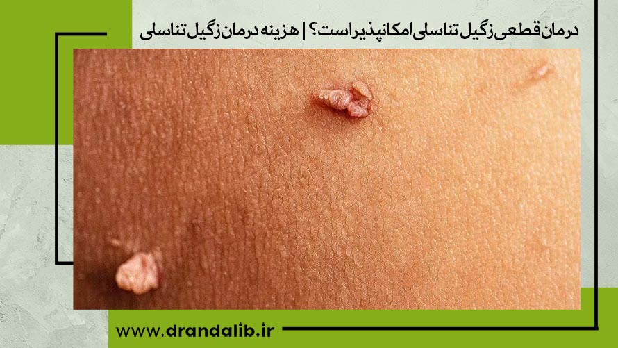 درمان زگیل تناسلی در اصفهان 