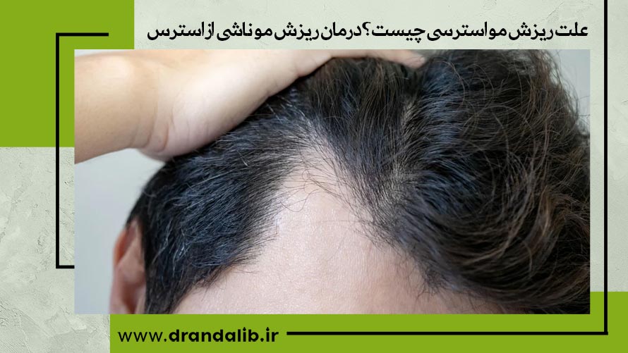 پیشگیری از ریزش موی استرسی