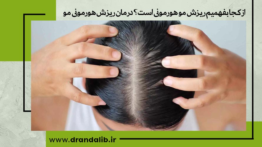 ریزش موی هورمونی چیست؟