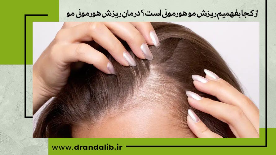 روش های درمان ریزش مو هورمونی
