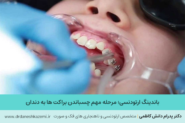 باندینگ ارتودنسی
