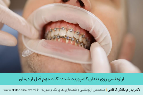 ارتودنسی روی کامپوزیت