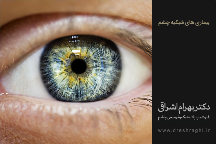 بیماری های شبکیه چشم
