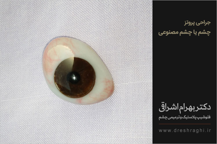 جراحی پروتز چشم