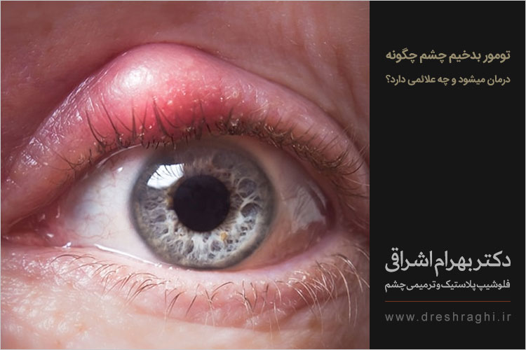 تومور بدخیم چشم