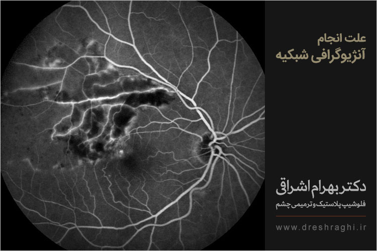 علت انجام آنژیوگرافی شبکیه