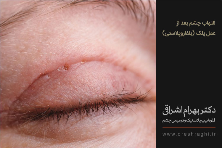 التهاب چشم بعد از عمل پلک