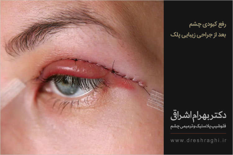 درمان ورم چشم بعد از عمل پلک
