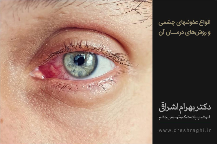 انواع عفونتهای چشمی