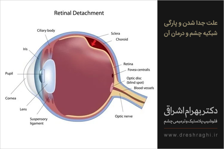 پارگی شبکیه چشم 