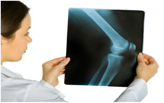 تشخیص علت زانو درد با رادیوگرافی