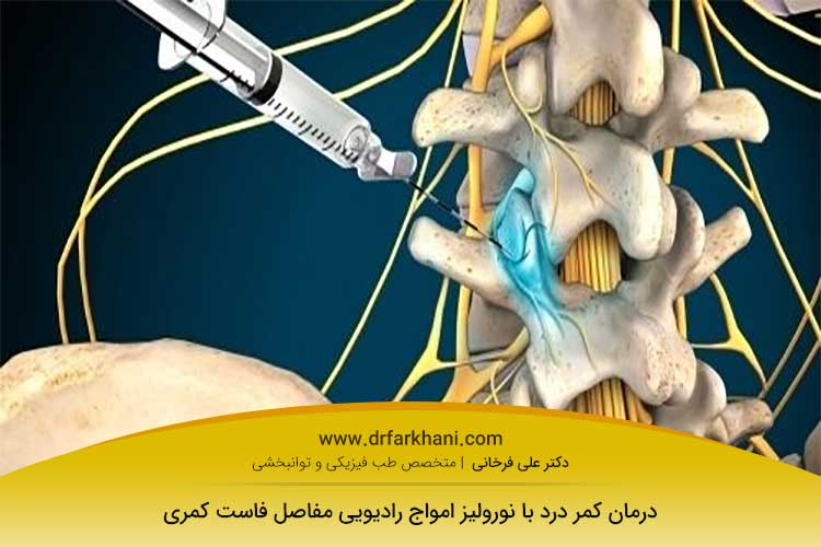 نورولیز امواج رادیویی مفاصل فاست کمری