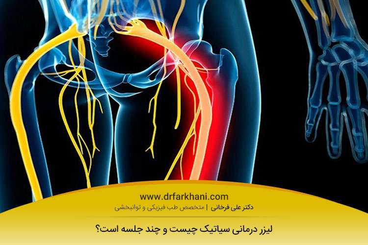 لیزر تراپی سیاتیک