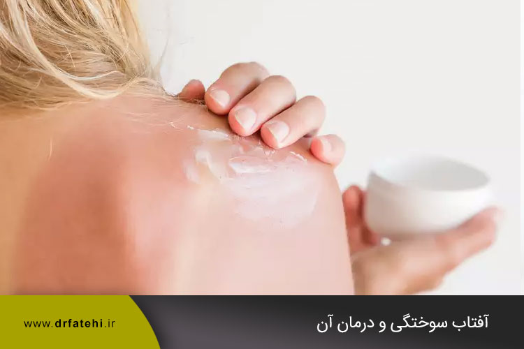 آفتاب  سوختگی