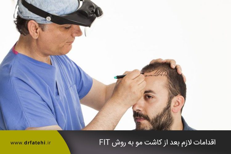 کاشت مو به روش FIT