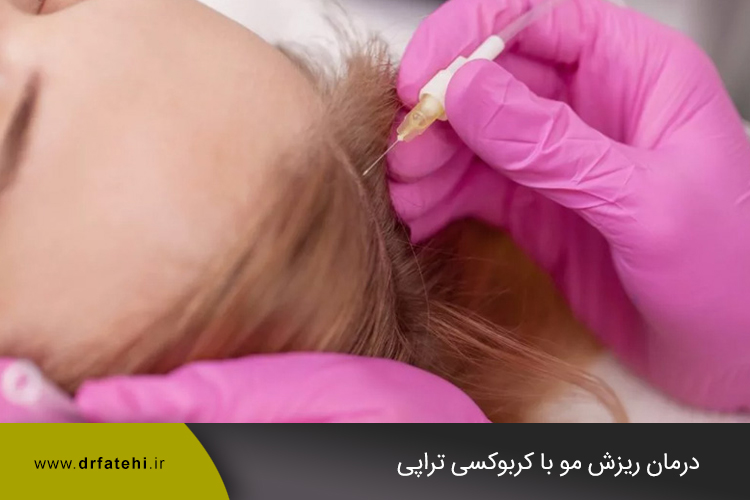 درمان ریزش مو با کربوکسی تراپی