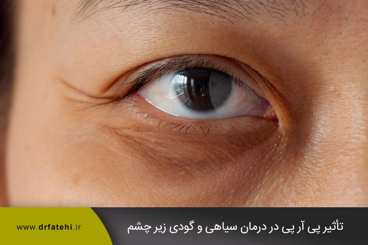 تأثیر پی آر پی در درمان سیاهی و گودی زیر چشم