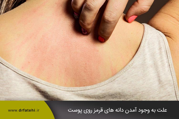 علت به وجود آمدن دانه های قرمز روی پوست