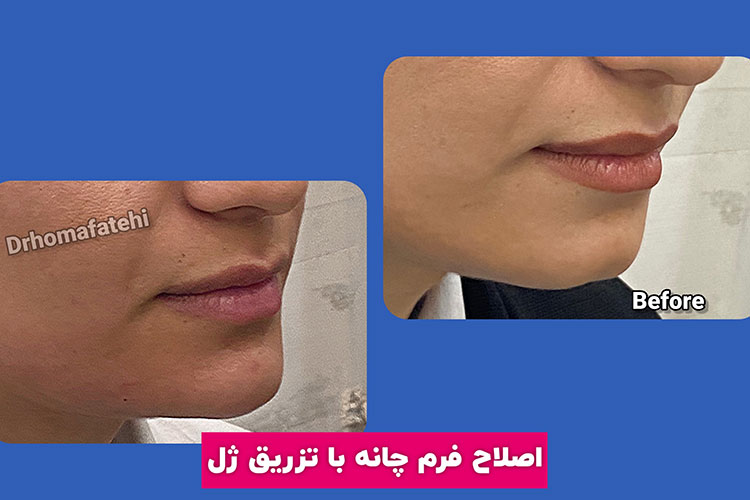 تزریق ژل به چانه در اصفهان عکس