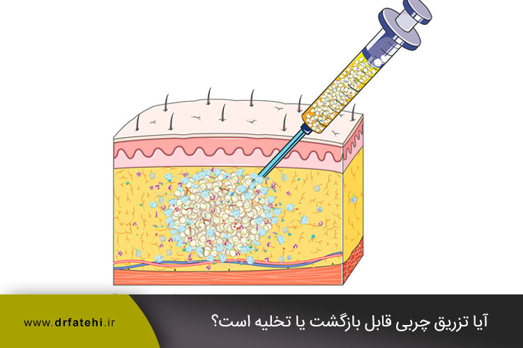 تخلیه چربی تزریق شده