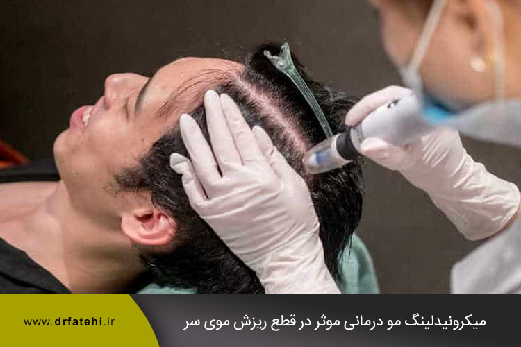 میکرونیدلینگ مو